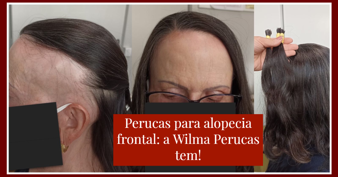 Perucas para alopecia frontal